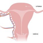 سرطان دهانه رحم