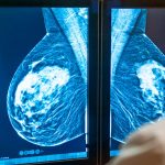 آیا سرطان سینه کشنده است