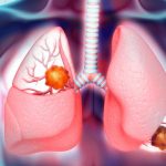 انواع سرطان ریه