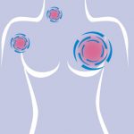 سرطان سینه چه علائمی دارد