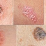 انواع سرطان پوست