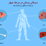 متاستاز سرطان سینه به مغز