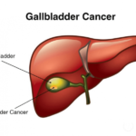 سرطان کیسه صفرا