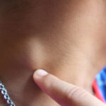 لنفوم هوچکین در کودکان