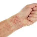 علائم کمبود پلاکت خون