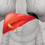 هموکروماتیس