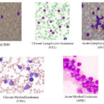 انواع سرطان خون