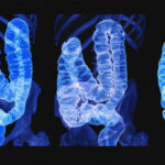 علائم اولیه سرطان روده