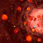 سرطان خون لنفوسیتی مزمن (CLL)