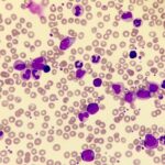 سرطان خون ملوئیدی مزمن