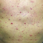 سرطان خون ملوئیدی حاد