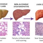 بالا بودن آنزیم کبدی در بارداری