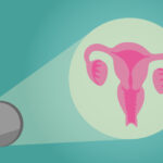 سرطان دهانه رحم