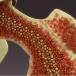 سندرم میلودیسپلاستیک