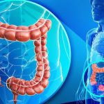 سرطان روده بزرگ