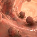 اندازه پولیپ روده بزرگ و خطر سرطان