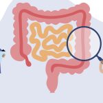 روش های تشخیص سرطان روده بزرگ