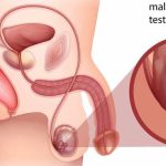 سرطان بیضه چیست؟
