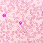 علت پایین بودن پلاکت خون