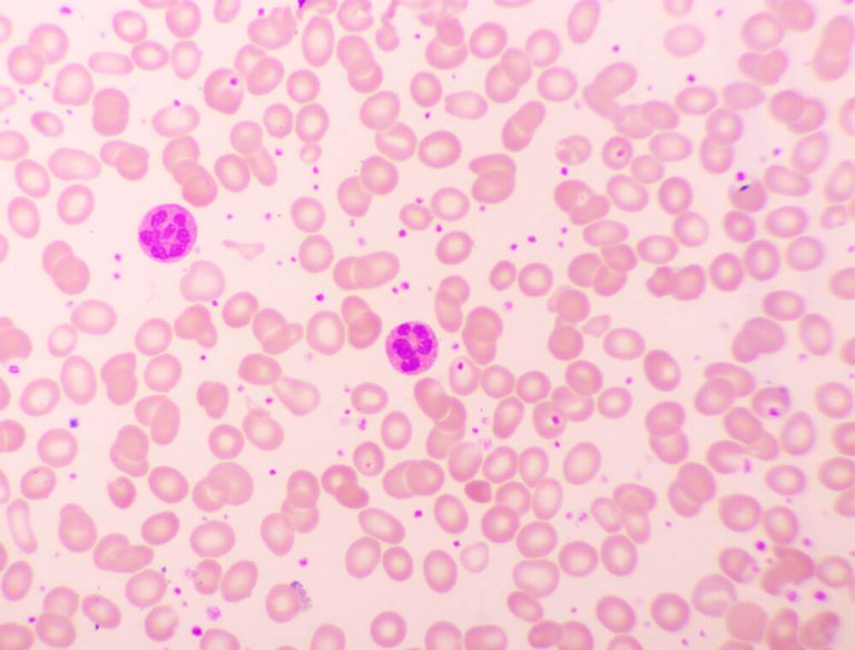 علت پایین بودن پلاکت خون چیست؟ آیا خطرناک است؟ دکتر حامد کیان