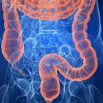 غربالگری سرطان روده بزرگ